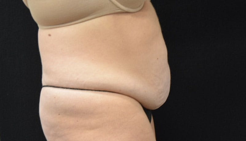Abdominoplasty Before & After Gallery - Patient 121686073 - Image 9