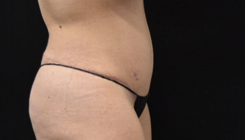 Abdominoplasty Before & After Gallery - Patient 121686073 - Image 10
