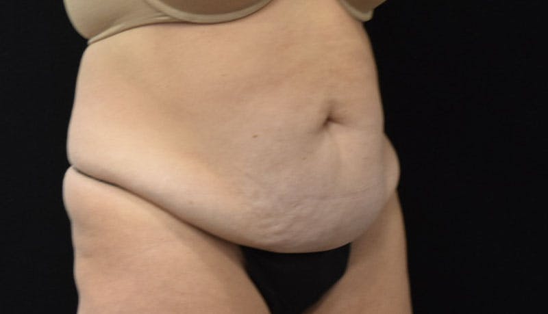 Abdominoplasty Before & After Gallery - Patient 121686073 - Image 11