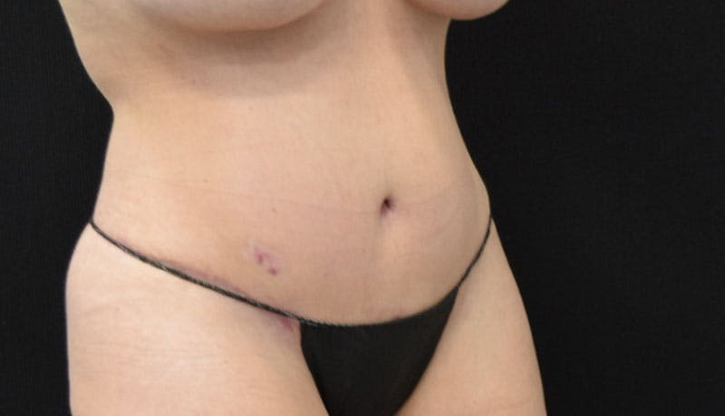 Abdominoplasty Before & After Gallery - Patient 121686073 - Image 12