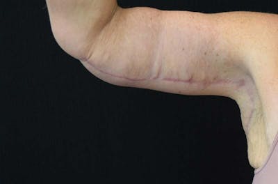 Brachioplasty Before & After Gallery - Patient 122228918 - Image 2