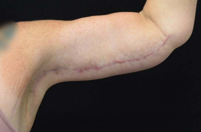 Brachioplasty Before & After Gallery - Patient 122228918 - Image 6