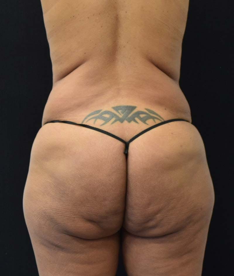 Lower Body Lift Before & After Gallery - Patient 122228979 - Image 11
