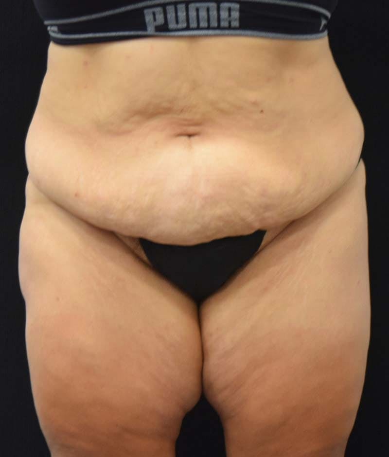 Lower Body Lift Before & After Gallery - Patient 122343322 - Image 1