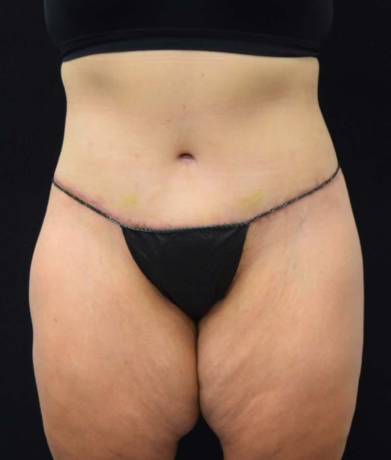 Lower Body Lift Before & After Gallery - Patient 122343322 - Image 2