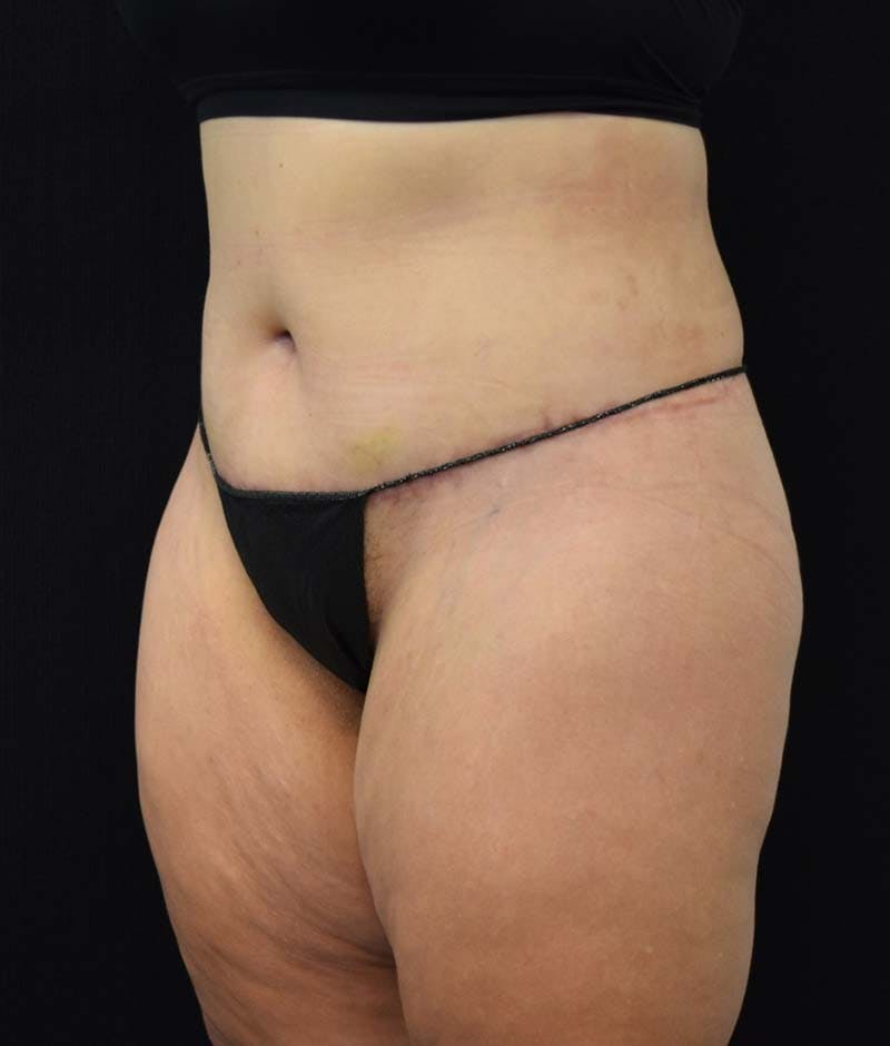 Lower Body Lift Before & After Gallery - Patient 122343322 - Image 4