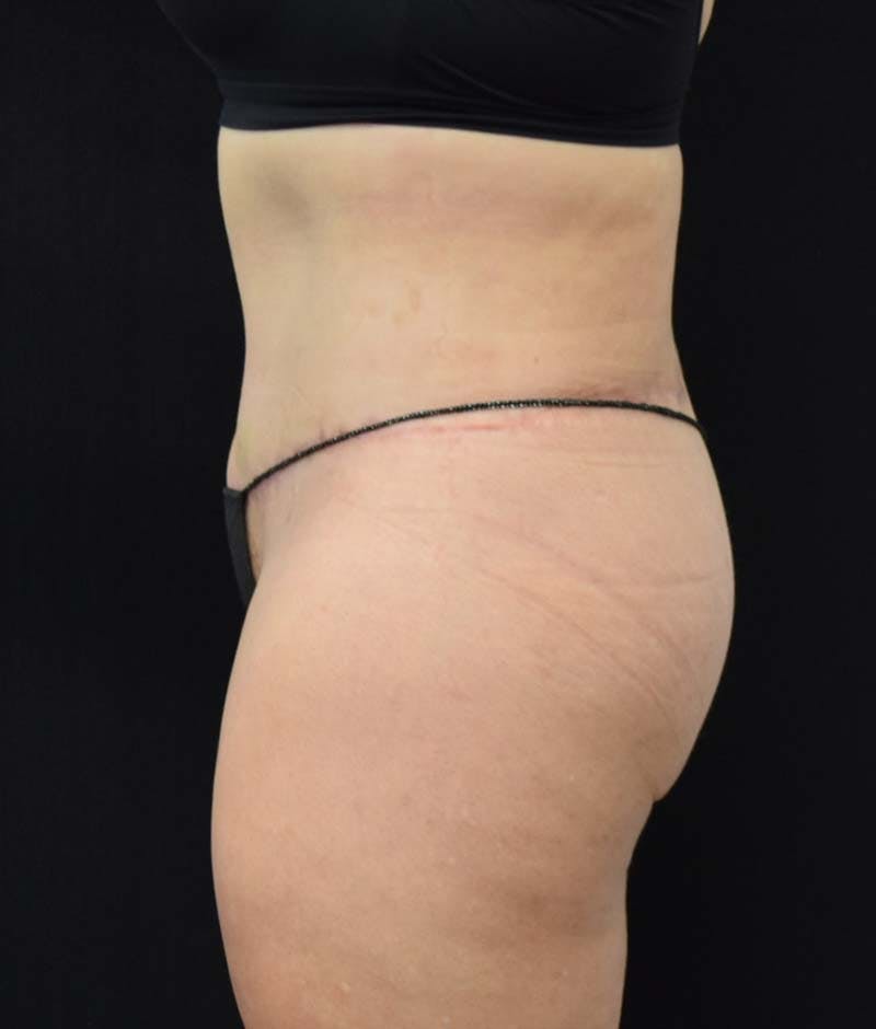 Lower Body Lift Before & After Gallery - Patient 122343322 - Image 6