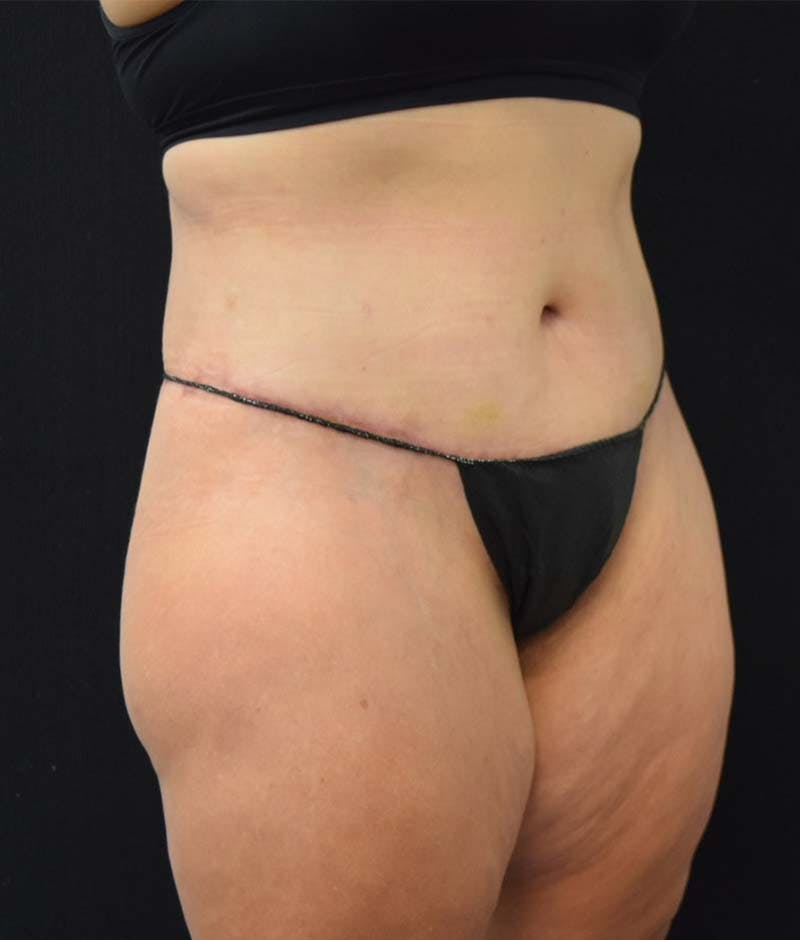 Lower Body Lift Before & After Gallery - Patient 122343322 - Image 10