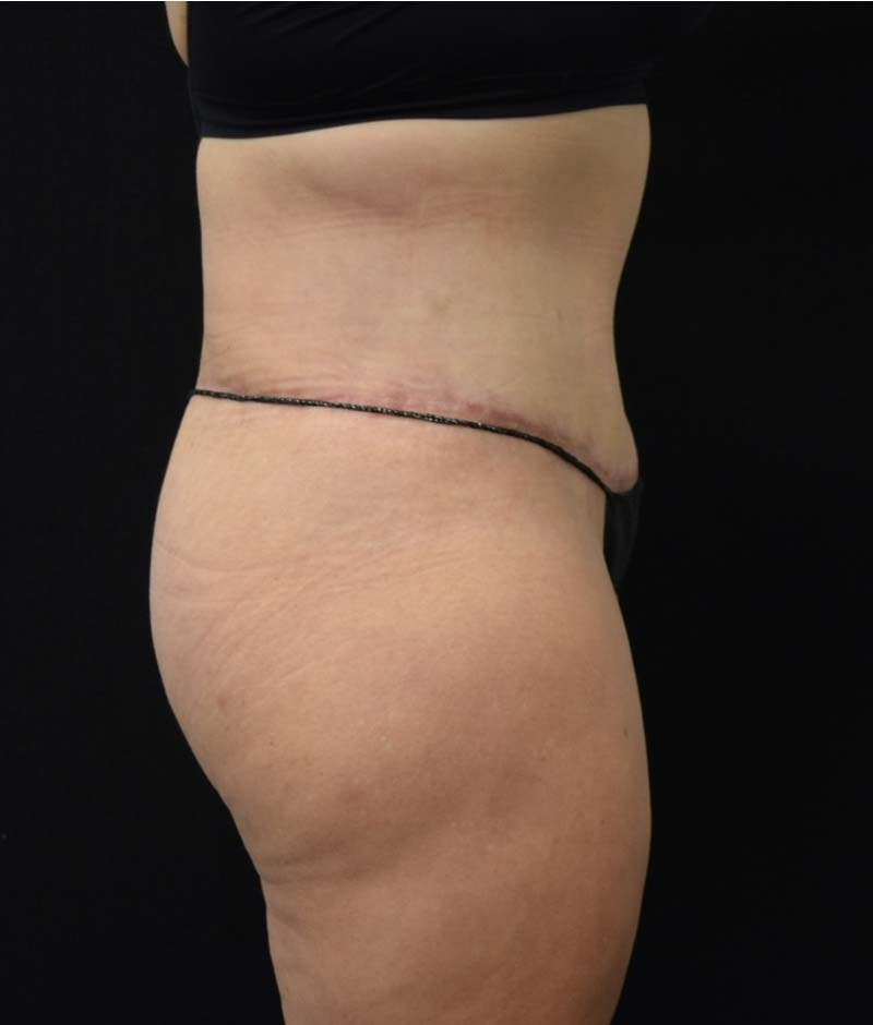 Lower Body Lift Before & After Gallery - Patient 122343322 - Image 12