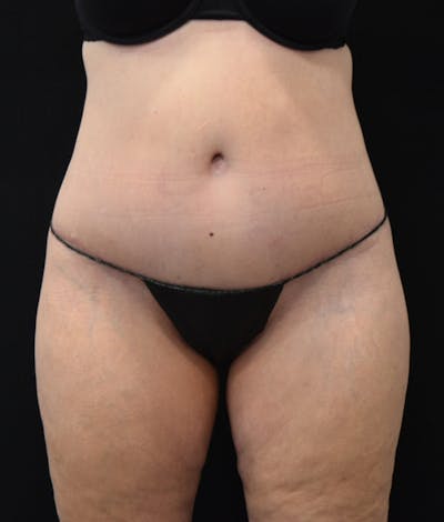 Lower Body Lift Before & After Gallery - Patient 122771320 - Image 2