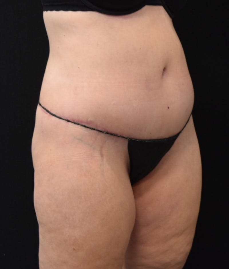 Lower Body Lift Before & After Gallery - Patient 122771320 - Image 4