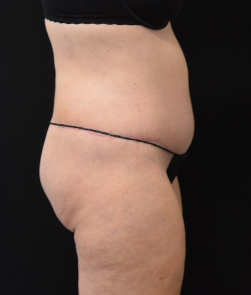 Lower Body Lift Before & After Gallery - Patient 122771320 - Image 6