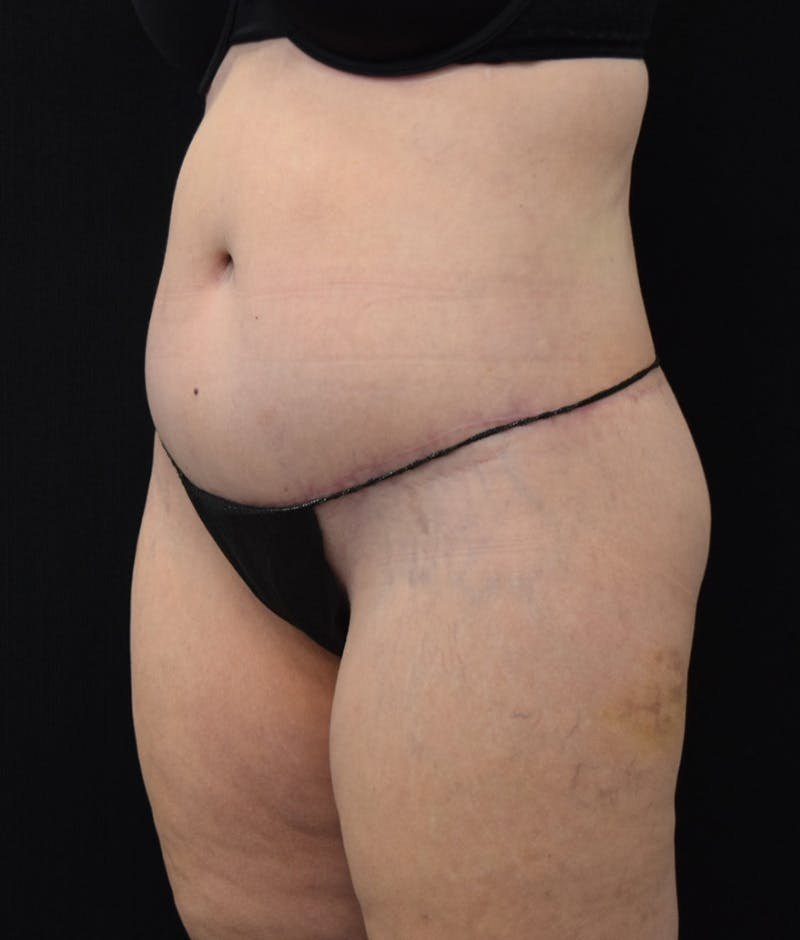 Lower Body Lift Before & After Gallery - Patient 122771320 - Image 8