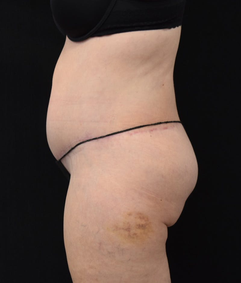 Lower Body Lift Before & After Gallery - Patient 122771320 - Image 10
