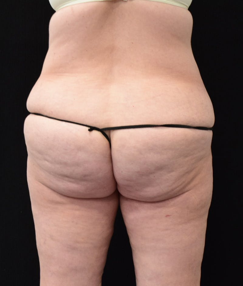 Lower Body Lift Before & After Gallery - Patient 122771320 - Image 11