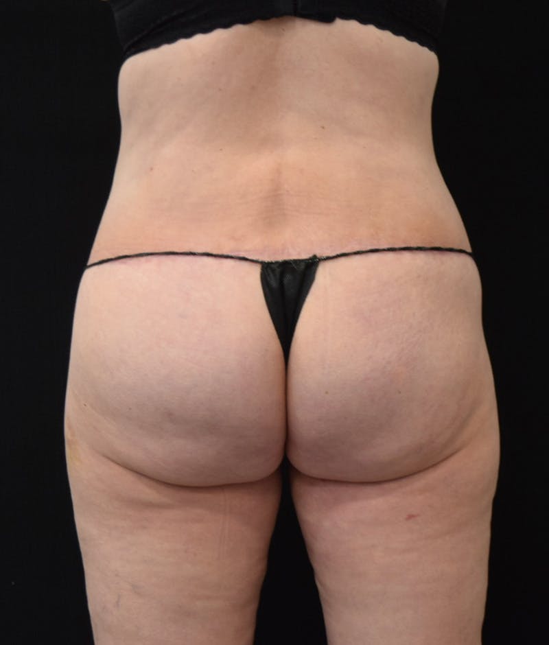 Lower Body Lift Before & After Gallery - Patient 122771320 - Image 12