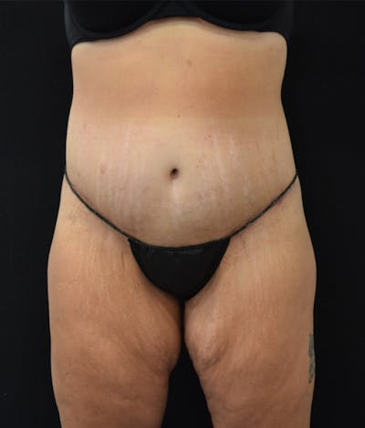 Lower Body Lift Before & After Gallery - Patient 122771352 - Image 2