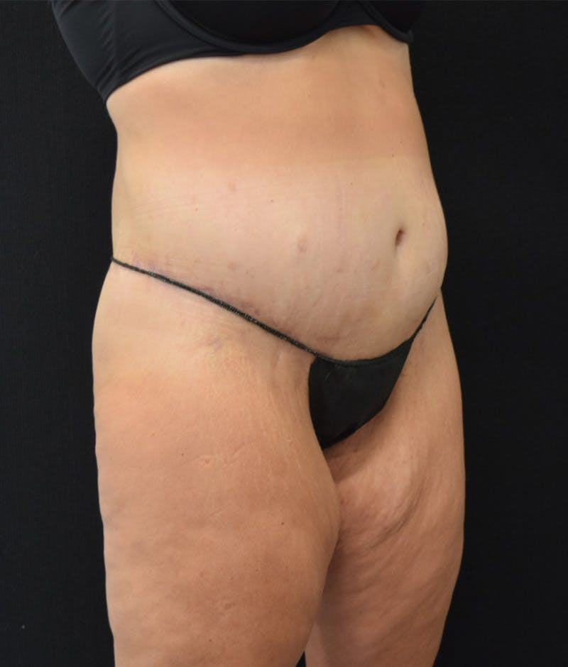 Lower Body Lift Before & After Gallery - Patient 122771352 - Image 4