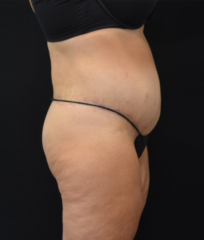 Lower Body Lift Before & After Gallery - Patient 122771352 - Image 6