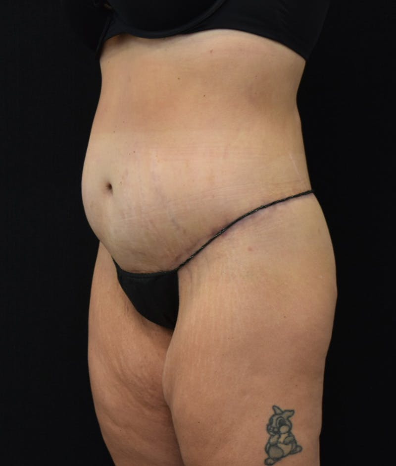 Lower Body Lift Before & After Gallery - Patient 122771352 - Image 8