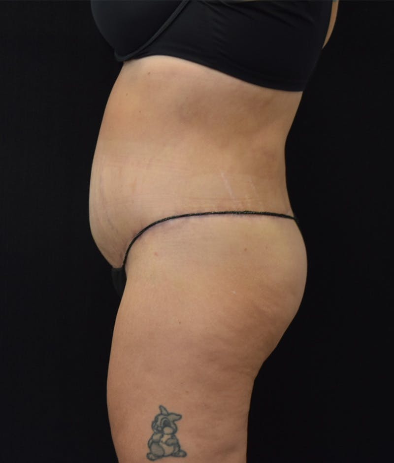 Lower Body Lift Before & After Gallery - Patient 122771352 - Image 10