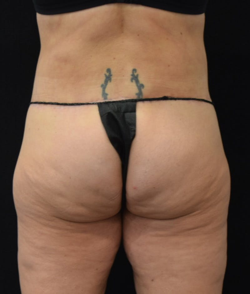 Lower Body Lift Before & After Gallery - Patient 122771352 - Image 12