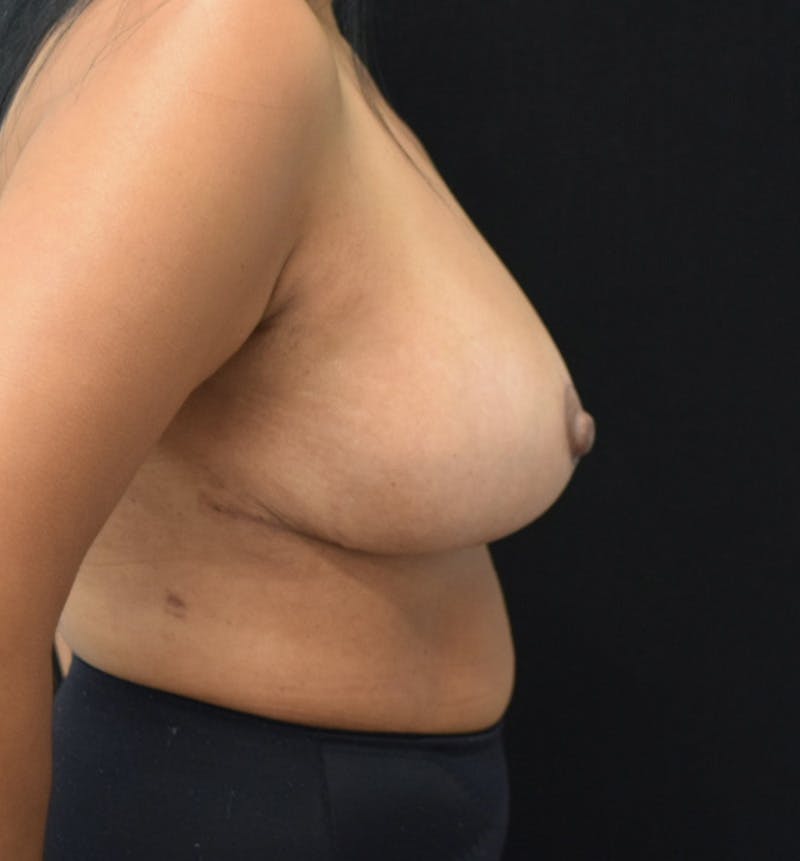 Breast Reduction Gallery - Patient 123455196 - Image 6