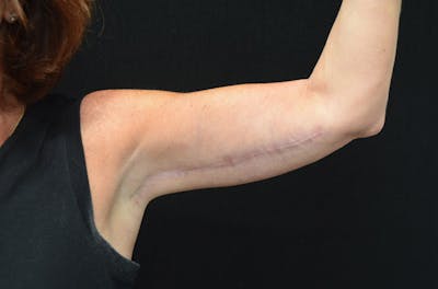 Brachioplasty Before & After Gallery - Patient 123455462 - Image 2