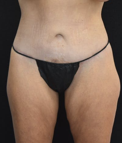 Lower Body Lift Before & After Gallery - Patient 142681561 - Image 2