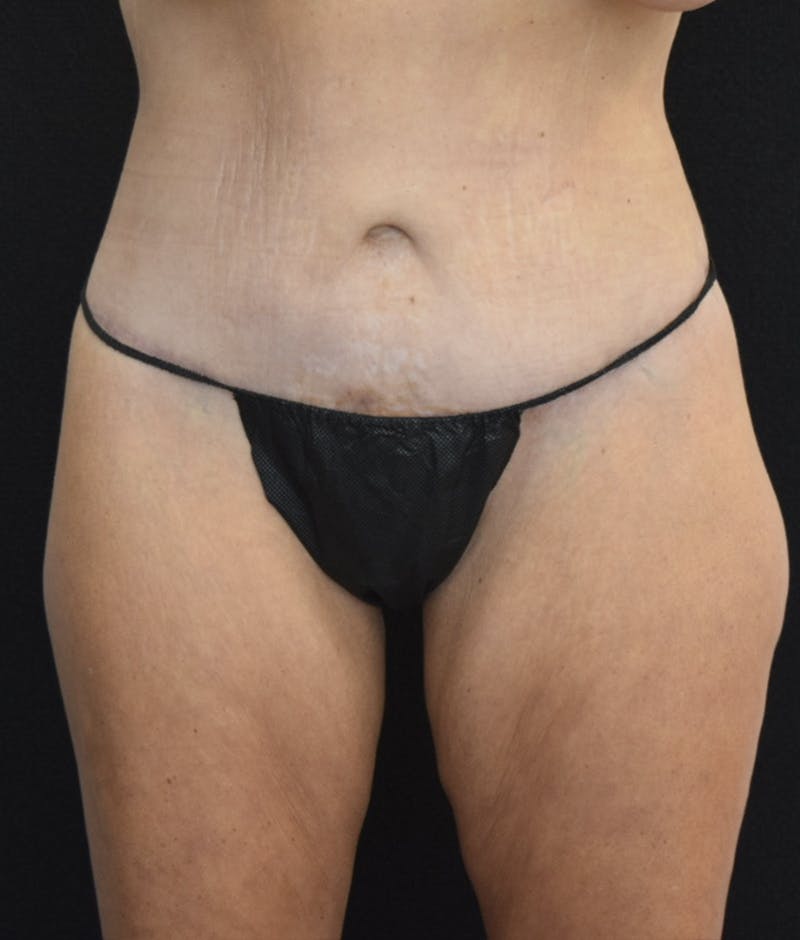 Lower Body Lift Before & After Gallery - Patient 142681561 - Image 2