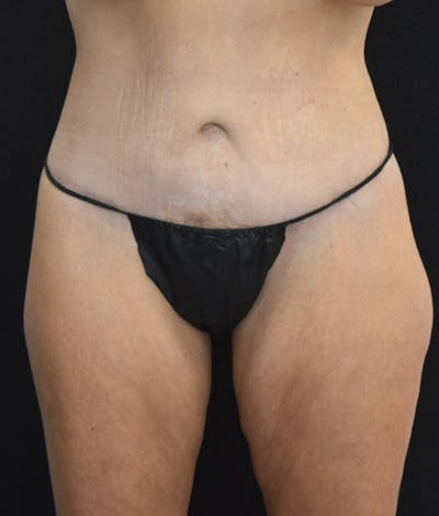 Lower Body Lift Gallery - Patient 123699716 - Image 2