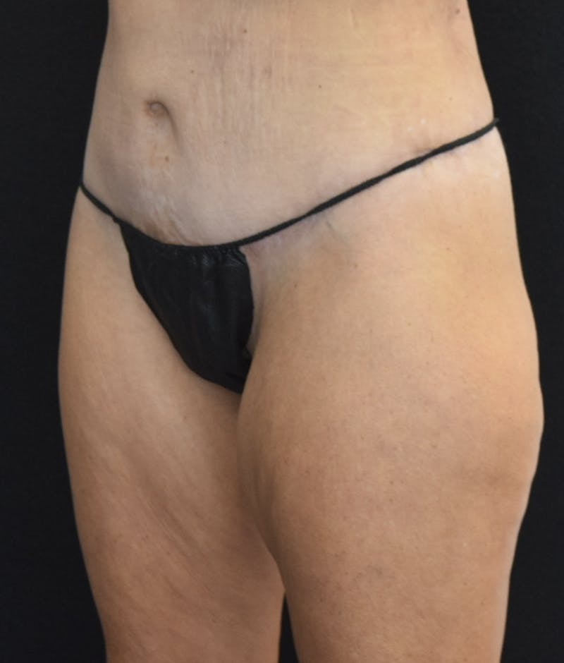 Lower Body Lift Before & After Gallery - Patient 142681561 - Image 4