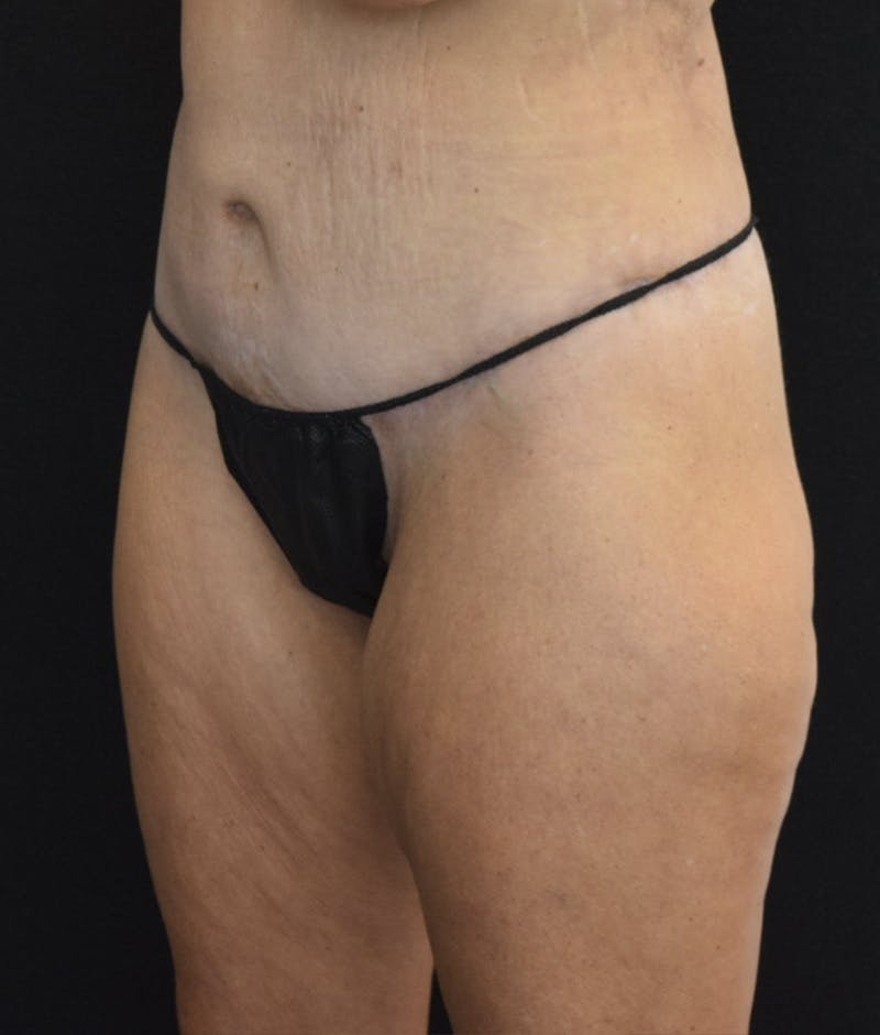 Lower Body Lift Before & After Gallery - Patient 142681561 - Image 6