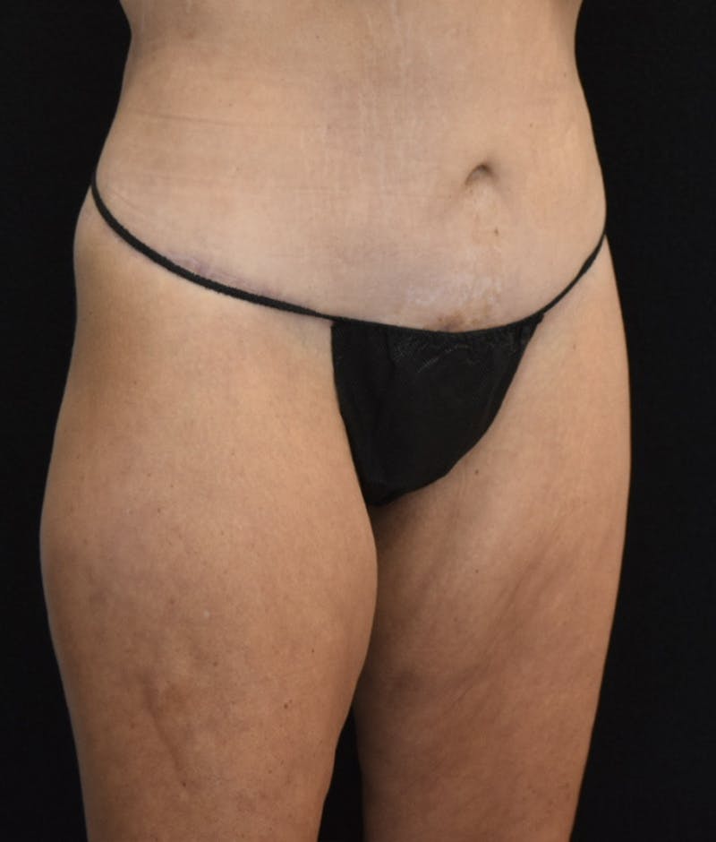 Lower Body Lift Before & After Gallery - Patient 142681561 - Image 8
