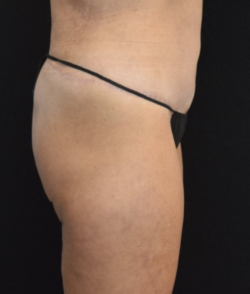Lower Body Lift Before & After Gallery - Patient 142681561 - Image 10