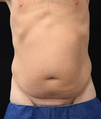 Male Lower Body Lift Before & After Gallery - Patient 148037518 - Image 1