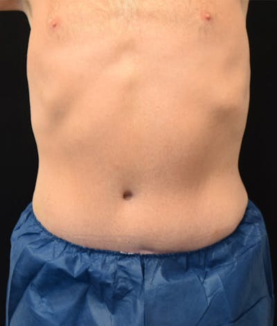Male Lower Body Lift Before & After Gallery - Patient 148037518 - Image 2
