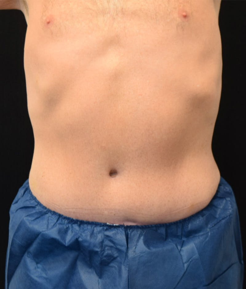 Male Lower Body Lift Before & After Gallery - Patient 148037518 - Image 2