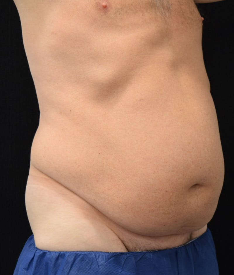 Male Lower Body Lift Before & After Gallery - Patient 148037518 - Image 3