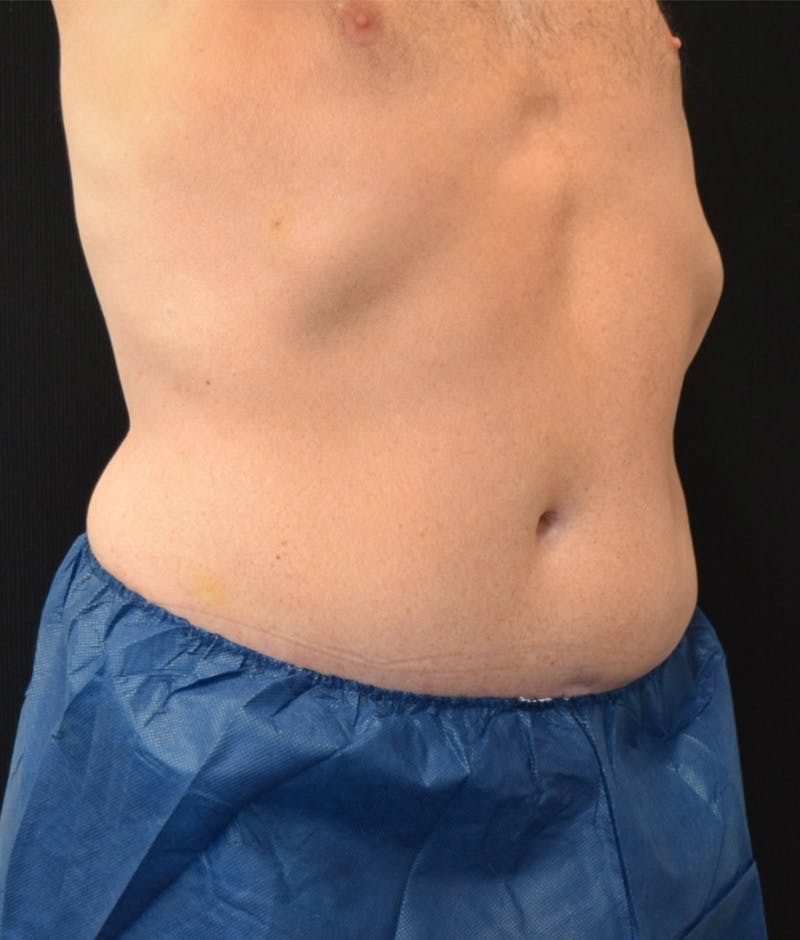Lower Body Lift Before & After Gallery - Patient 141201271 - Image 4