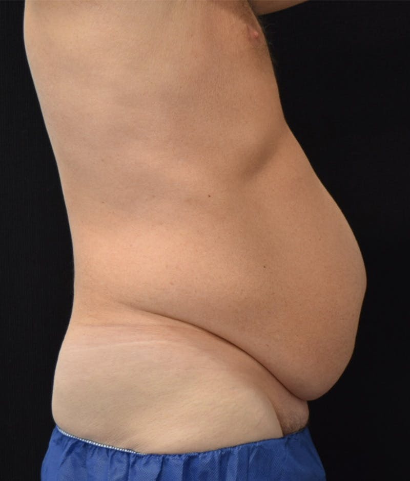 Lower Body Lift Before & After Gallery - Patient 141201271 - Image 5