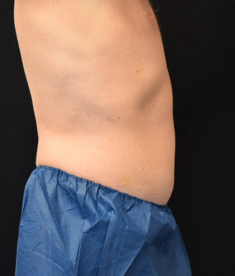 Lower Body Lift Before & After Gallery - Patient 148037518 - Image 6