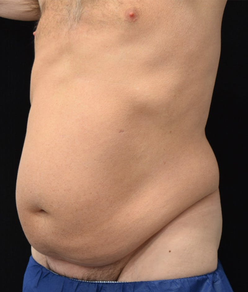 Male Lower Body Lift Before & After Gallery - Patient 148037518 - Image 7