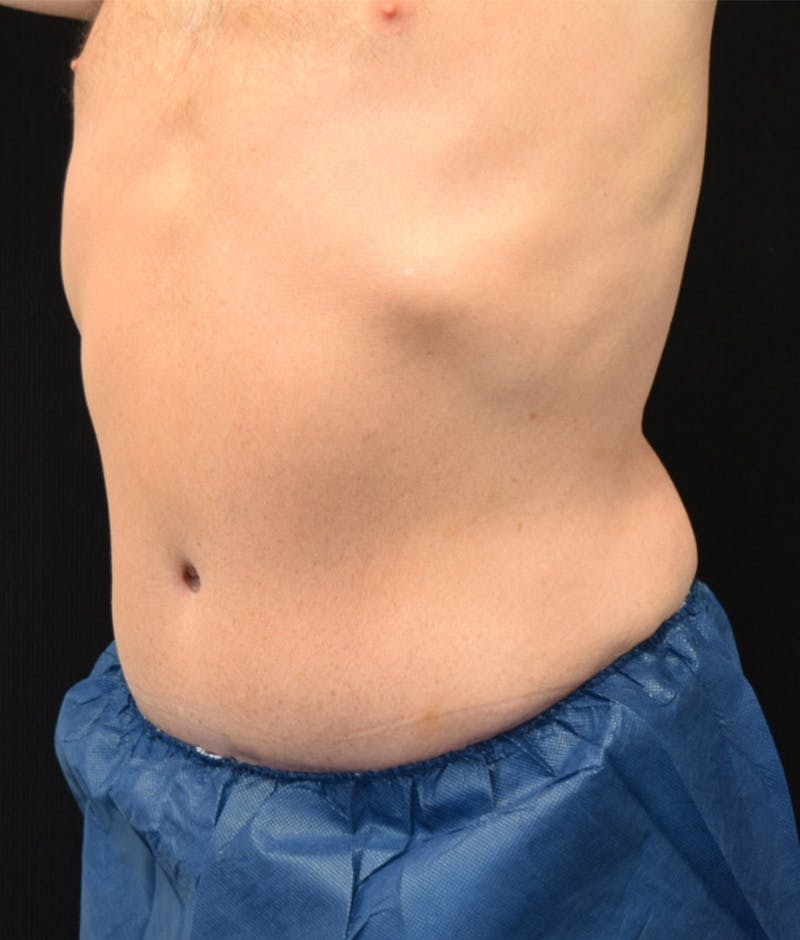 Male Lower Body Lift Before & After Gallery - Patient 148037518 - Image 8