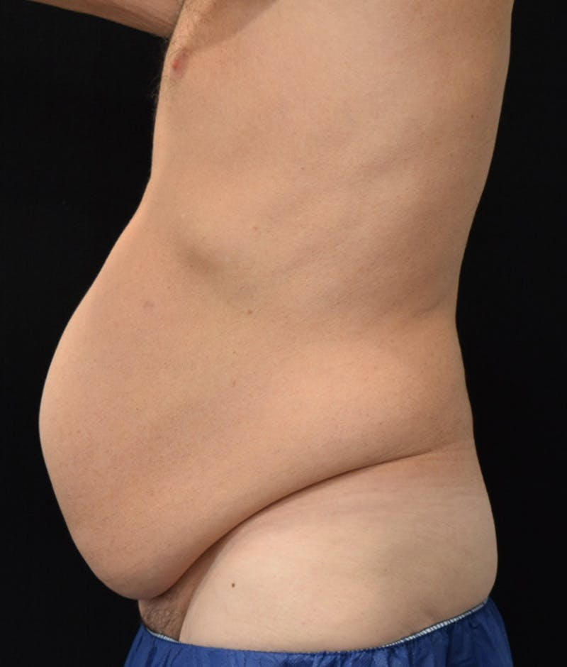 Male Lower Body Lift Before & After Gallery - Patient 148037518 - Image 9