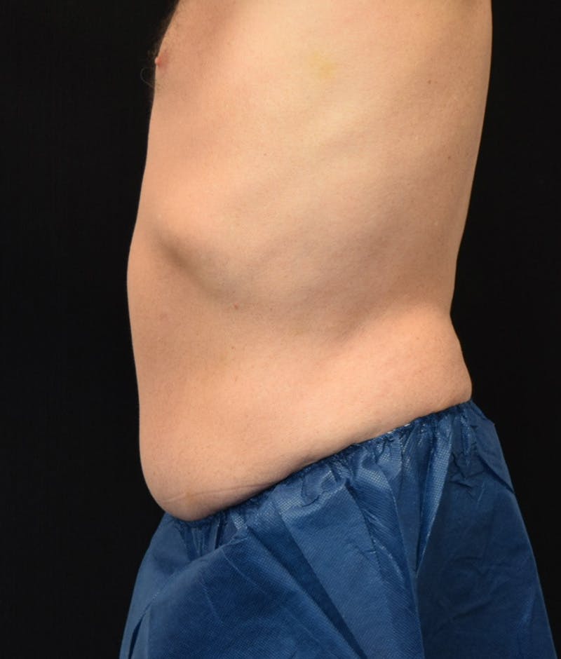 Male Lower Body Lift Before & After Gallery - Patient 148037518 - Image 10