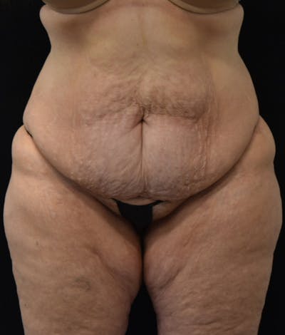 Lower Body Lift Before & After Gallery - Patient 142681560 - Image 1