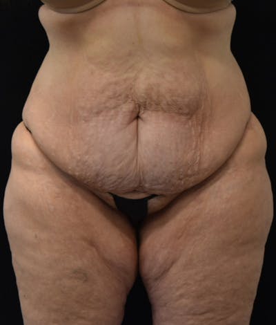Lower Body Lift Before & After Gallery - Patient 142681560 - Image 1