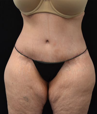 Lower Body Lift Before & After Gallery - Patient 142681560 - Image 2