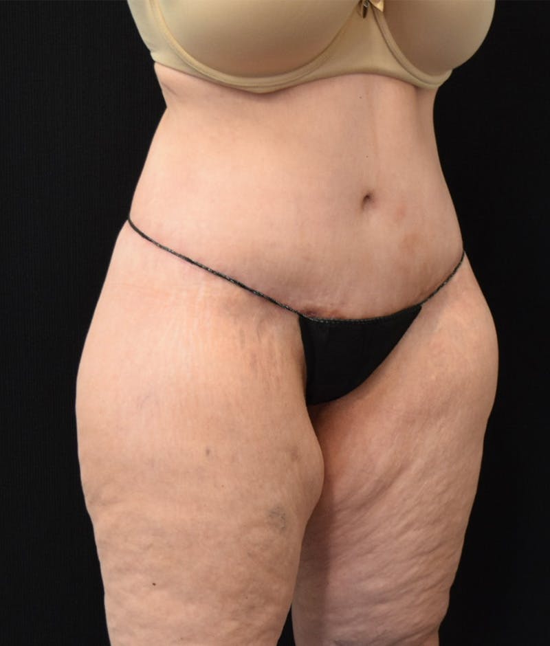 Lower Body Lift Before & After Gallery - Patient 142681560 - Image 4